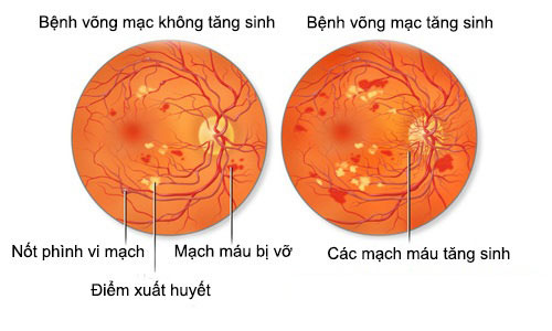 Màng tăng sinh trước võng mạc - Hình ảnh minh họa